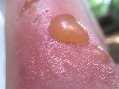 why is my sunburn leaking yellow|Sunburn Blisters: Signs, Symptoms & Treatment For。